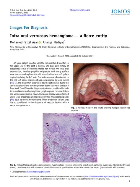 Intra Oral Verrucous Hemangioma − A Fierce Entity Journal Of Oral