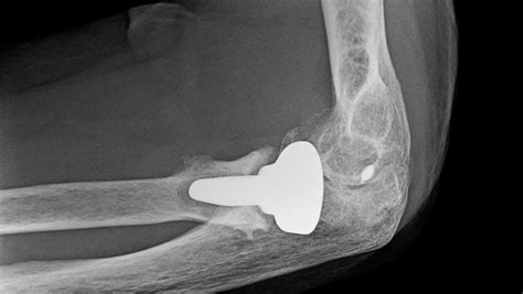 Press Fit Radial Head Arthroplasty Showing Osteolysis Chondral