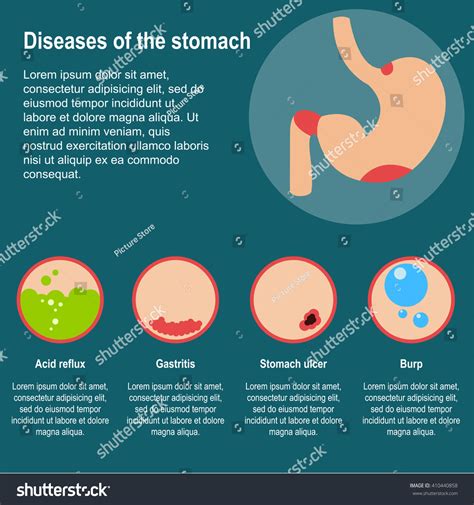 Diseases Stomach Vector Illustration Damage Stomach Stock Vector