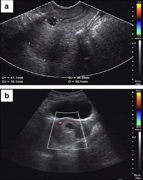 transvaginal ultrasound guided embryo aspiration plus local administration of low dose