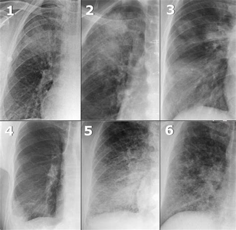Chest X Ray Bronchitis Vs Pneumonia
