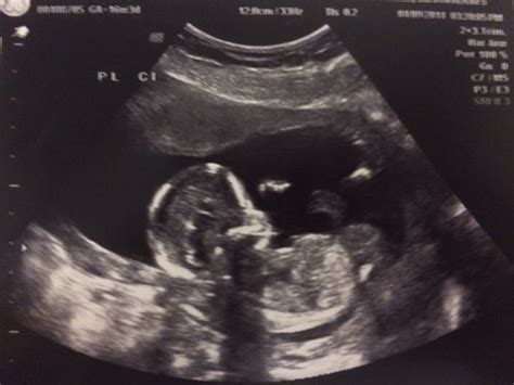 16 Week Ultrasound Gender Pics Babycenter