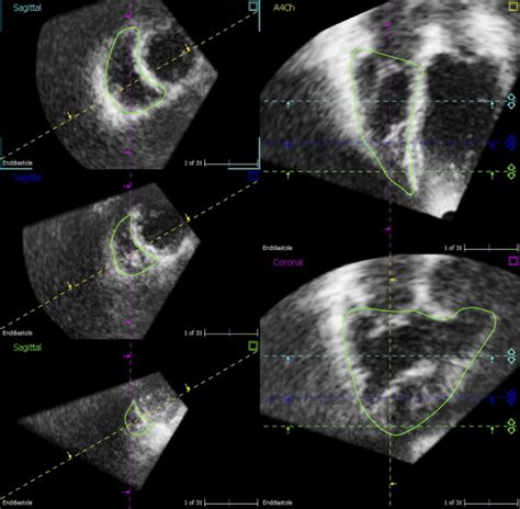 Usefulness Of Real Time Three Dimensional Echocardiography To Identify