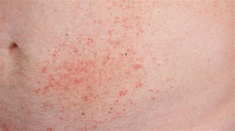 Dermatitis Herpetiformis Causes Symptoms And Diagnosis