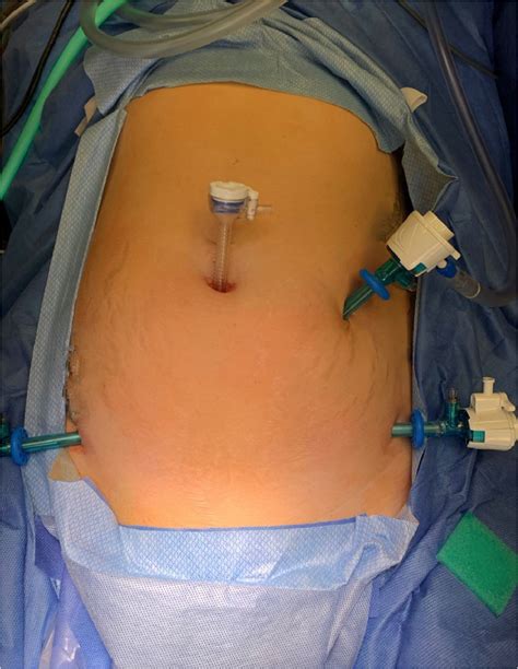 Clinical Perspective Concerning Abdominal Entry Techniques Journal Of Minimally Invasive