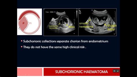 Placental Hemorrhage Ultrasound