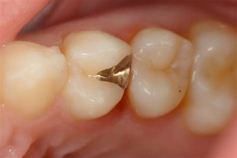 Dental Gold Fillings And Inlays The Ultimate Dentistry V5 The