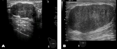 A And B Initial Ultrasound Of Right Breast Showing A Solid