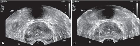 Transrectal Ultrasound Of Prostate Telegraph