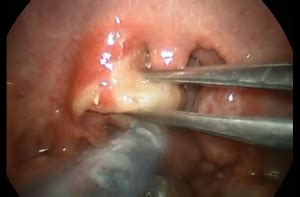 The palatal tonsils are bundles of lymphoid tissue that are found at the back of the throat. Surgical Solutions for Tonsil Stones | Tonsil Stones
