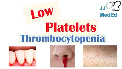Low Platelets In Pregnancy Symptoms Pregnancywalls