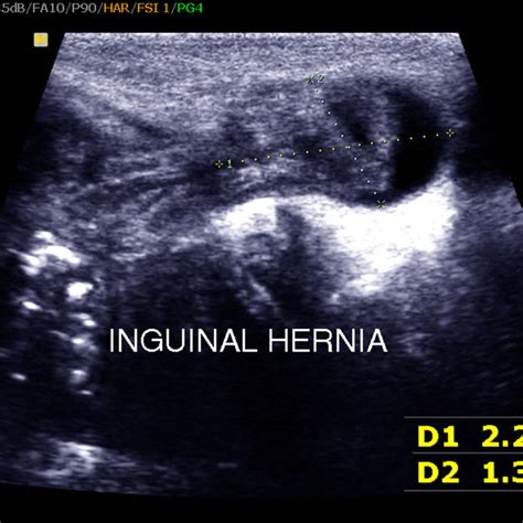Pdf Inguinoscrotal And Inguinolabial Swelling In Infancy Role Of