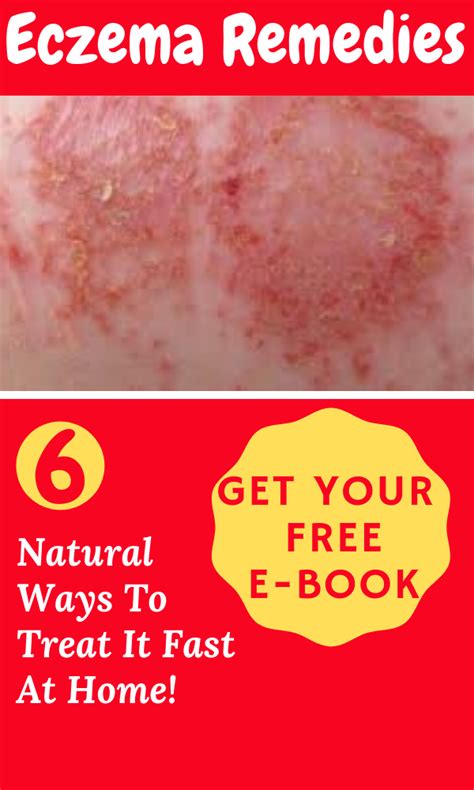 Eczema Remedies 6 Natural Ways To Treat It Fast At Home Eczema