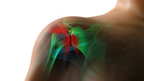 Rotator Cuff Tendinopathy Above And Beyond Physical Therapy