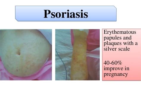 Pruritus In Pregnancy