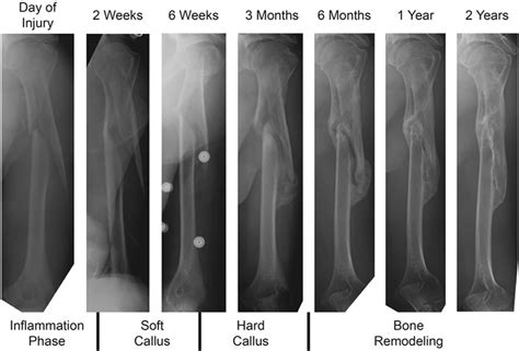 Divided the whole period of secondary fracture healing into four biomechanical stages, based on the results of torsion tests. Clinical example of humerus fracture healing. | Download ...