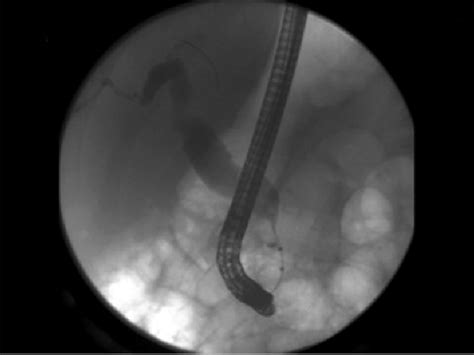 Ercp Smooth Concentric Narrowing Of The Distal Common Bile Duct
