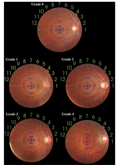 Figure 1 From Characteristics Of Fundal Changes In Fundus Tessellation