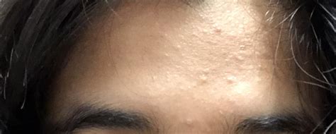Skin Colored Bumps On Forehead Naturalskins
