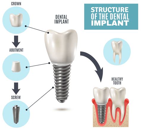 Dental Implant Specialist In Phoenix Az Dental Implants In Az