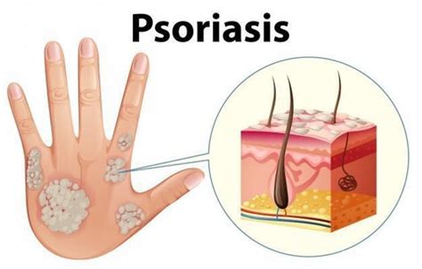 Penyakit ini dapat memengaruhi seluruh sistem. Jenis-jenis Psoriasis, Penyakit Kulit Menahun yang Tidak ...