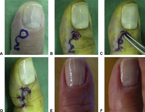 The Zitelli Bilobed Flap On Skin Coverage After Mucous Cyst Excision A