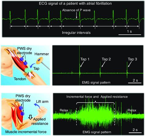 Clinical Evaluation Of Pws Electrodes For Ecg And Emg A Ecg Signals