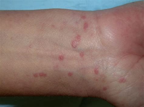 What Causes An Autoimmune Rash 10 Possible Conditions Pictures