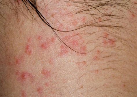 Curious About Atopic Dermatitis Heres What You Need To Know