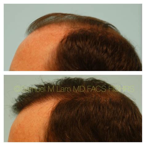 This Gentleman Is Shown Before And After Hair Transplant Hair