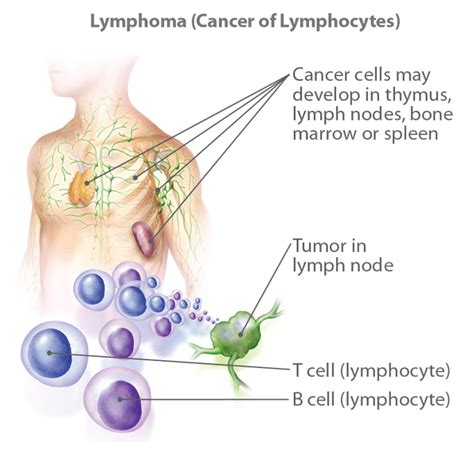 Learn About Non Hodgkin Lymphoma Information Facts Overview