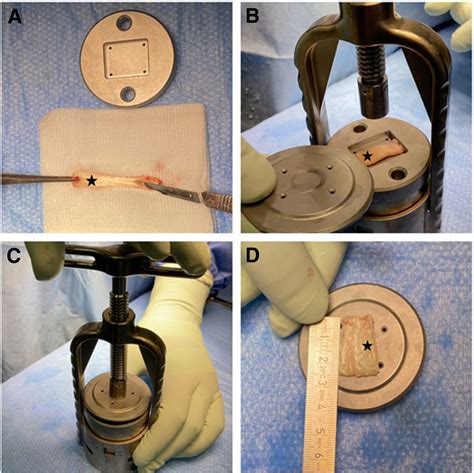 Biceps Smash Technique Biceps Tendon Autograft Augmentation For Arthroscopic Rotator Cuff