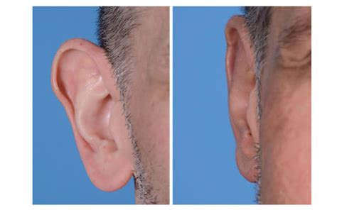 Cosmetic Ear Surgery In Gurgaon Best Otoplasty Surgeon
