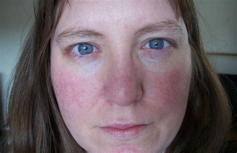 Red Face When Exercising Normal Or Not Exercisewalls