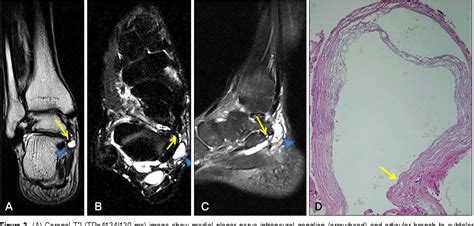 Figure 3 From Intraneural Ganglion Cyst In Foot And Ankle Semantic