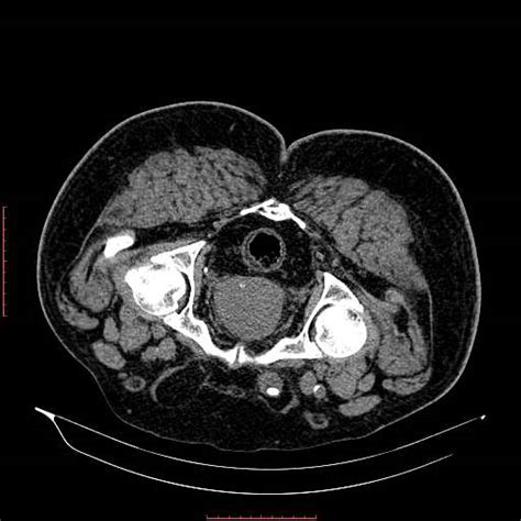 Urinary Bladder Hernia And Calculi Image