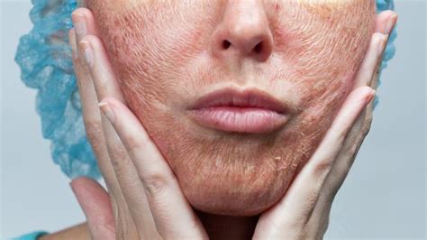 Get all of your questions answered on realself. Women buying 'chemical peels' on eBay suffering from acid ...