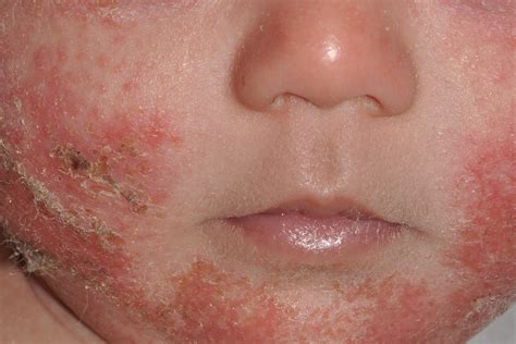 10 Dermatitis O Eczemas