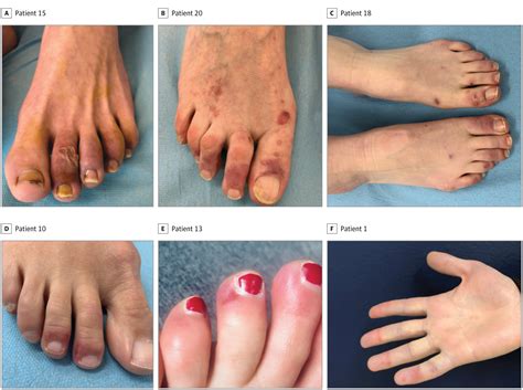 Evaluation Of Chilblains As A Manifestation Of The Covid 19 Pandemic