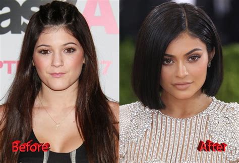 Kylie Jenner Plastic Surgery Facts Rumors And News