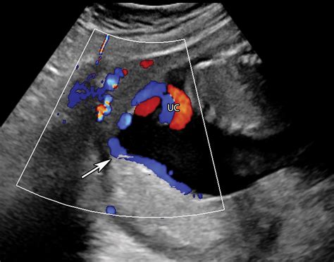 Placental Imaging Normal Appearance With Review Of Pathologic Findings