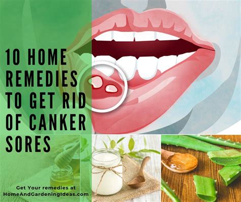 10 Home Remedies To Get Rid Of Canker Sores Home And Gardening Ideas