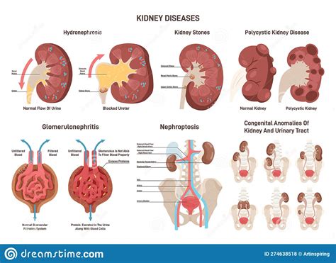Kidney Diseases Set Renal Failure Urinary System Organ Medical Stock