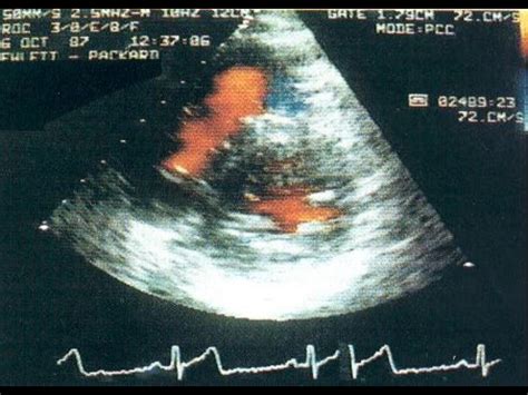 2 D Echo Doppler Lecture Basic And Normal Cases