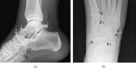 Ankle And Foot Radiology Key