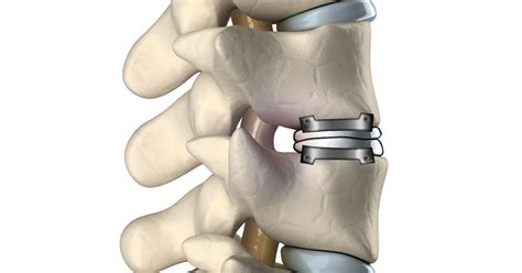 Cervical Spinal Disc Prosthesis Implant Market May See Big Move