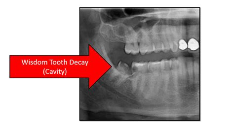 Wisdom Teeth And Other Extractions