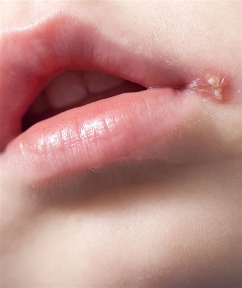 Wenn der andere keine bläschen oder so hat und also einen gesunden mund hat, kann man sich trzd. Herpes Lippe Ansteckend Wie Lange | Liptutor.org