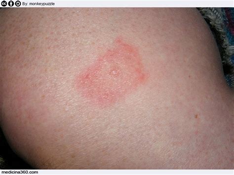 Puntura di zecca: sintomi, terapia e rimedi naturali