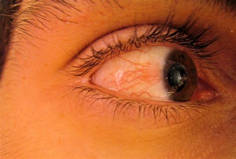 Causes Of Eye Redness And How To Naturally Soothe Irritated Eyes